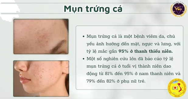 Ảnh: Mụn tuổi dậy thì – Chăm sóc an toàn và hiệu quả